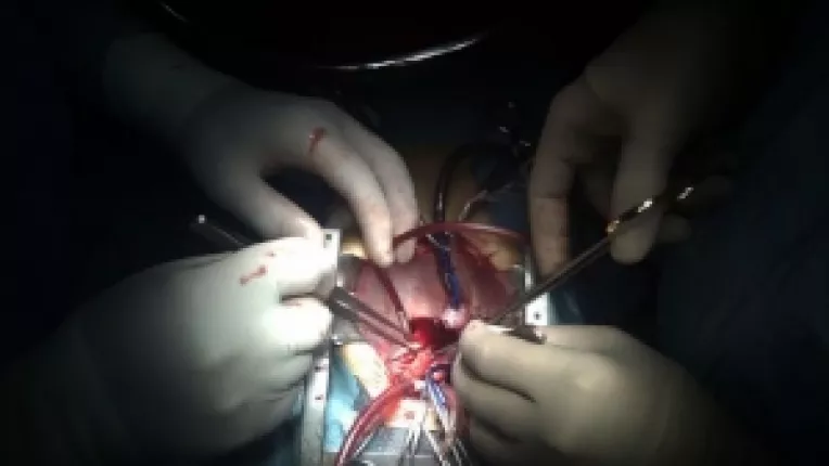 Cresterea constanta a numarului de transplanturi